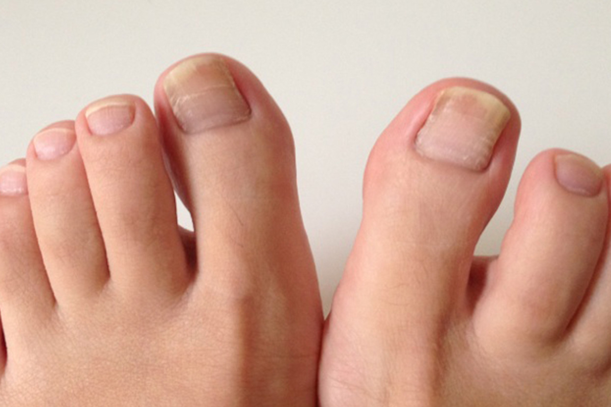 爪水虫処理施術